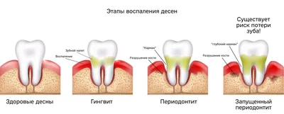 Экструзия: сломанный зуб можно вытянуть! | Videdent.ru