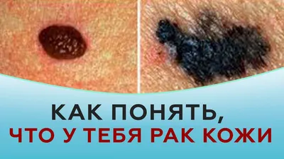 Раскрыты пять неожиданных симптомов рака кожи: 17 марта 2023, 09:50 -  новости на Tengrinews.kz