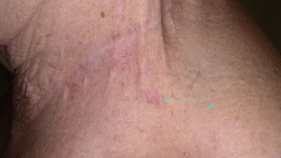 Первично-множественный рак кожи : dr_jamais — LiveJournal