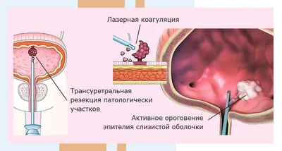 Цистоскопия – исследование мочевого пузыря: показания, противопоказания.  Как проводится цистоскопия