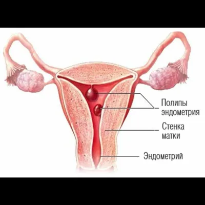 Полип уретры у женщин ≡ Лечение полипа уретры | Клиника Биляка