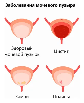 Полипы уретры у женщин и мужчин: удаление, лечение, симптомы