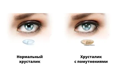 Катаракта глаза: симптомы, лечение и операция по удалению в Москве в ФНКЦ  ФМБА
