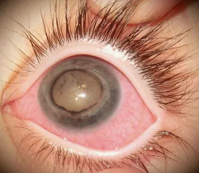 Катаракта - симптомы и лечение лазером - профилактика начинающейся ядерной катаракты  глаза