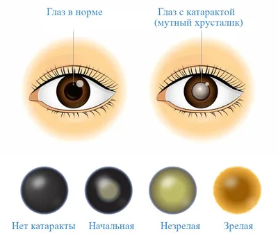 Лечение осложненной катаракты в Москве, диагностика и лечение катаракты в  Центре Терапевтической Офтальмологии