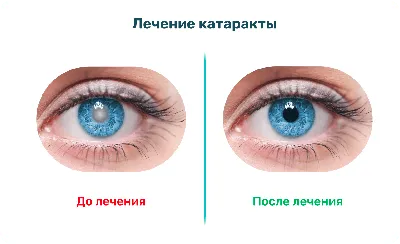 Причины развития катаракты (помутнения хрусталика глаза)