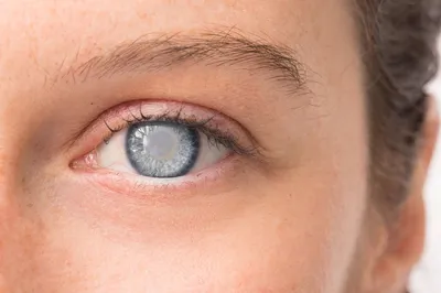 Возрастная катаракта: причины возникновения, стадии развития, эффективное  лечение - Офтальмологические клиники «Эксимер» (Киев) – диагностика и  лечение заболеваний глаз у взрослых и детей