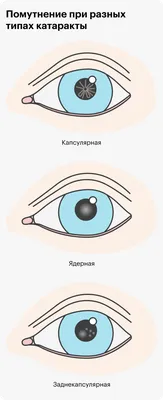 Лечение катаракты в Санкт-Петербурге - цена операции в клинике «Счастливый  Взгляд»