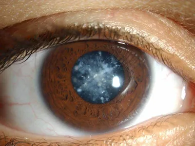 Катаракта: симптомы, причины, лечение, операция по удалению, замена  хрусталика глаза