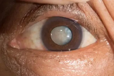 Реабилитация после лечения катаракты в Саратове, восстановление пожилых  людей после операции на глаза