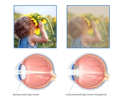 Катаракта: симптомы, причины, лечение, операция по удалению, замена  хрусталика глаза