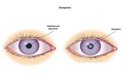 Катаракта у детей