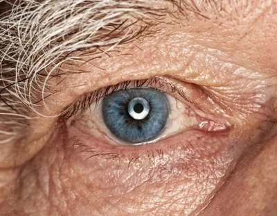 Катаракта | Симптомы катаракты | Лечение катаракты