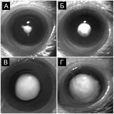 Лечение катаракты – Центр микрохирургии глаза