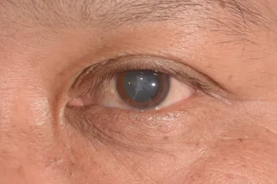 Вторинна катаракта – що це, причини, симптоми та лікування | Блог | GlazGo