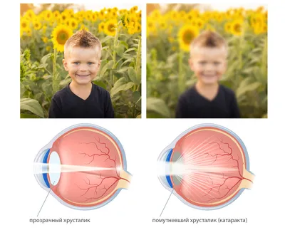 Незрелая катаракта глаз – симптомы и лечение