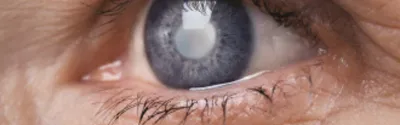 Что такое катаракта и как её победить?