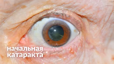 Симптомы катаракты, профилактика и лечение