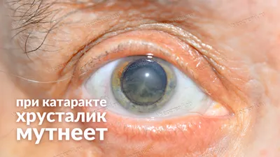 Катаракта - симптомы и лечение лазером - профилактика начинающейся ядерной  катаракты глаза