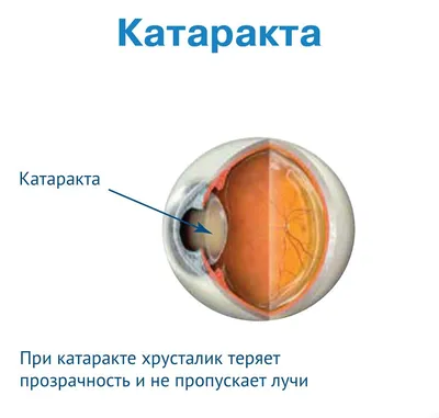 Были ли у вас когда-нибудь заболевания глаз?Поговорим о Катаракте! |  Поговорим? | Дзен