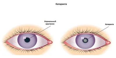 Катаракта в пожилом возрасте, причины, симптомы, профилактика и лечение