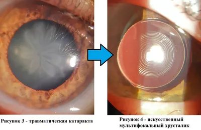МНЕНИЕ ЭКСПЕРТА: Катаракта -Наши новости
