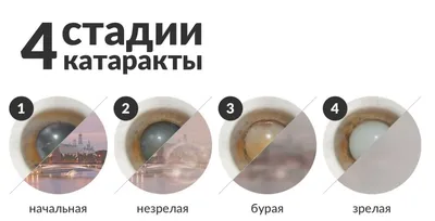 Катаракта: первые симптомы, признаки, причины | Пансионаты «Забота о  близких» | Дзен