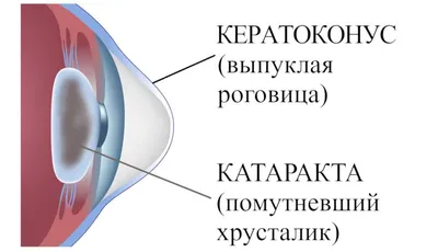 Катаракта начальной стадии - признаки, как лечить