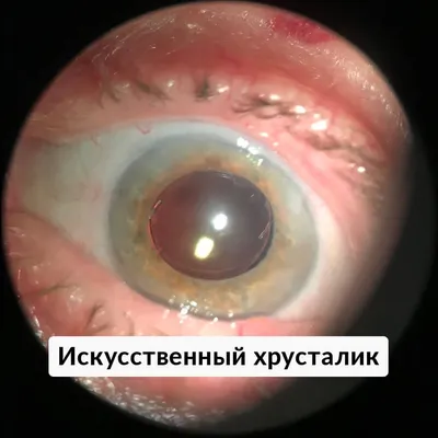 Замена помутневшего хрусталика глаза (катаракта) при кератоконусе
