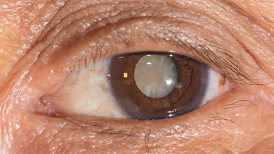 Лечение катаракты, цены и отзывы на операцию по удалению катаракты —  офтальмологическая клиника Леге Артис