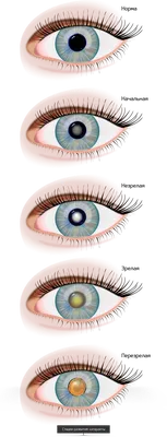 Катаракта симптомы и причины возникновения. Виды и стадии катаракты глаза