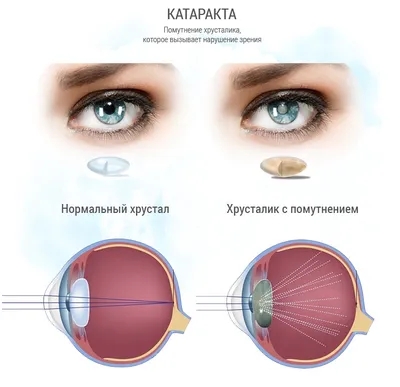 Незрелая катаракта глаза, лечение и проведение операции в клинике г. Москва