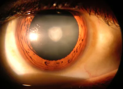 Что такое катаракта и как её победить?