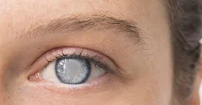 Гимнастика для глаз при катаракте