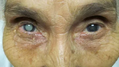 Причины развития катаракты (помутнения хрусталика глаза)