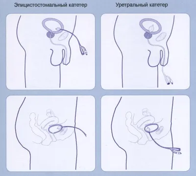 Мочевыводящая система и катетер | АКЦЕПТ плюс