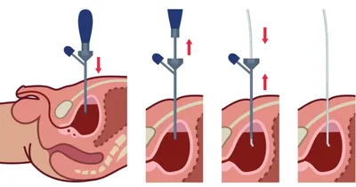 Мочевые катетеры: виды, как использовать и ухаживать