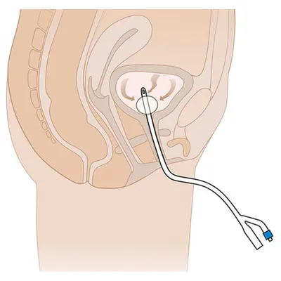 Катетер Фолея урологический стерильный | Купить по оптовой цене в \"АМС-Мед\"