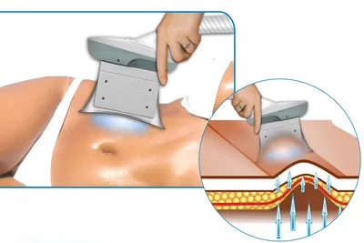 Кавитация: фото до и после | 300 ЭКСПЕРТОВ | Дзен
