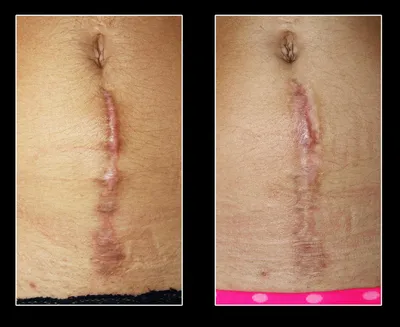 Scars treatment | LINLINE Medical Systems