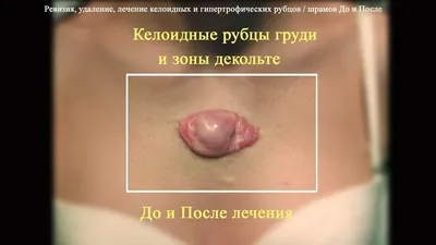 Удаление шрамов и рубцов | Damas Medical Center