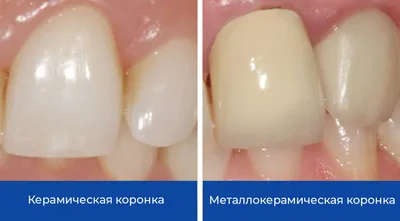 Керамические коронки на зубы: цена установки на передние и жевательные |  НоваДент