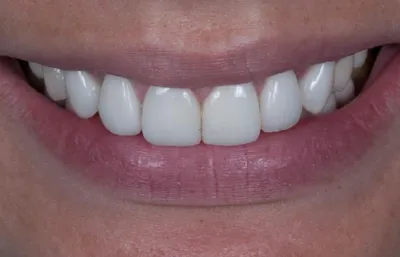 Металлокерамическая коронка - протезирование зуба