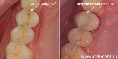 Керамические коронки