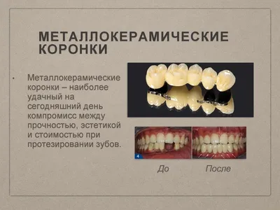 Коронки металлокерамические, цельнокерамические