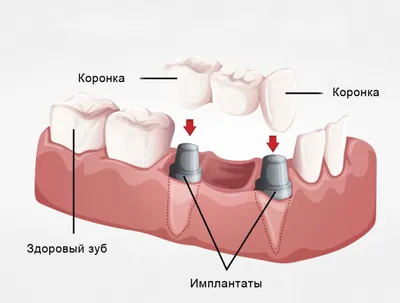 Керамические коронки - Стоматология \"Дантист\" в Воронеже