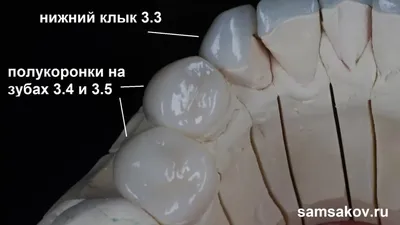 Металлокерамическая коронка недорого Киев