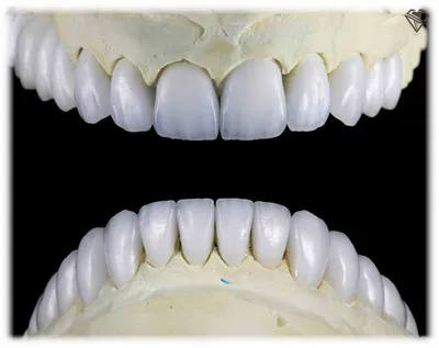Керамические коронки на зубы - плюсы, минусы и цена каждого вида с фото |  Альянс бьюти-ортопедов, Москва