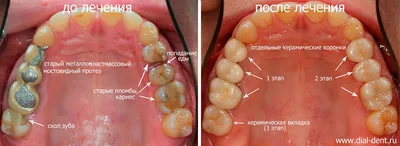 Цены на керамические коронки. Сколько стоят безметалловые протезы зубов в  Ростове-на-Дону — РостДент