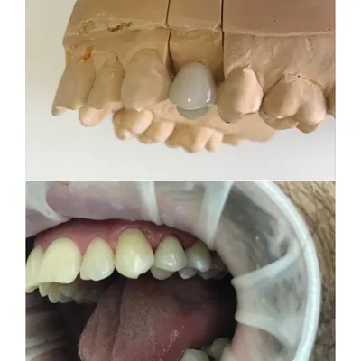 Керамические коронки для коррекции формы и цвета передних зубов